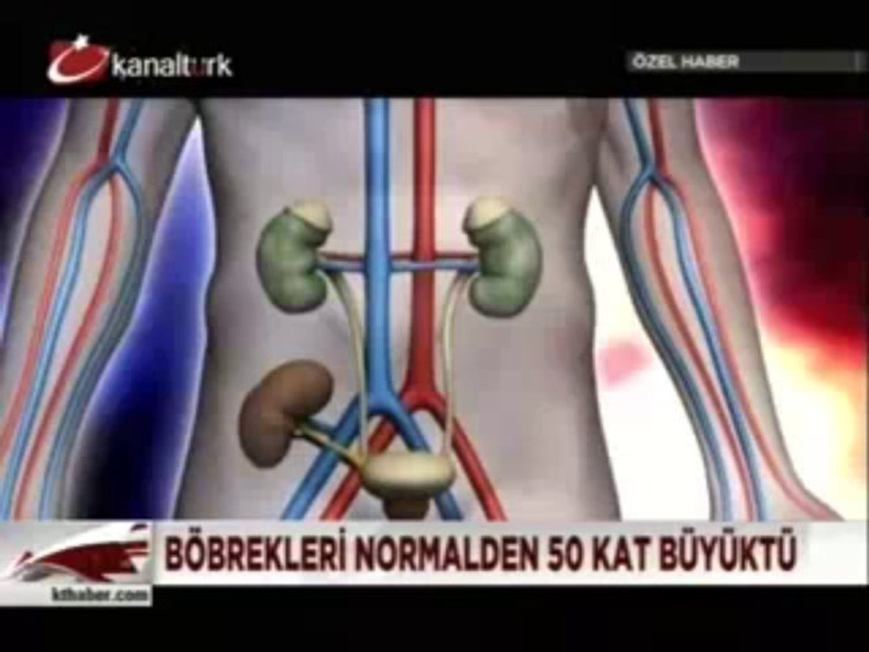 Böbrek nakli