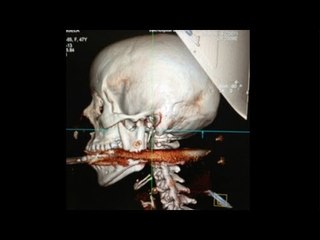 Speargun accident: Woman survives harpoon shot through the mouth