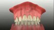 Dental Implants Virginia Beach - Dental Implant Procedure-3
