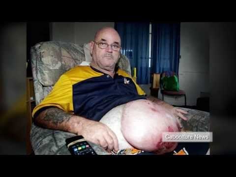 Parasite puts man in coma with grotesque stomach infection