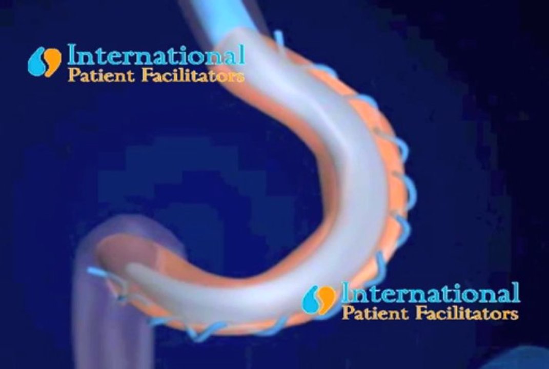 3d Gastric Plication Surgery