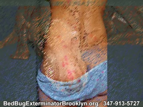 Bed Bug Exterminator in Brooklyn NYC