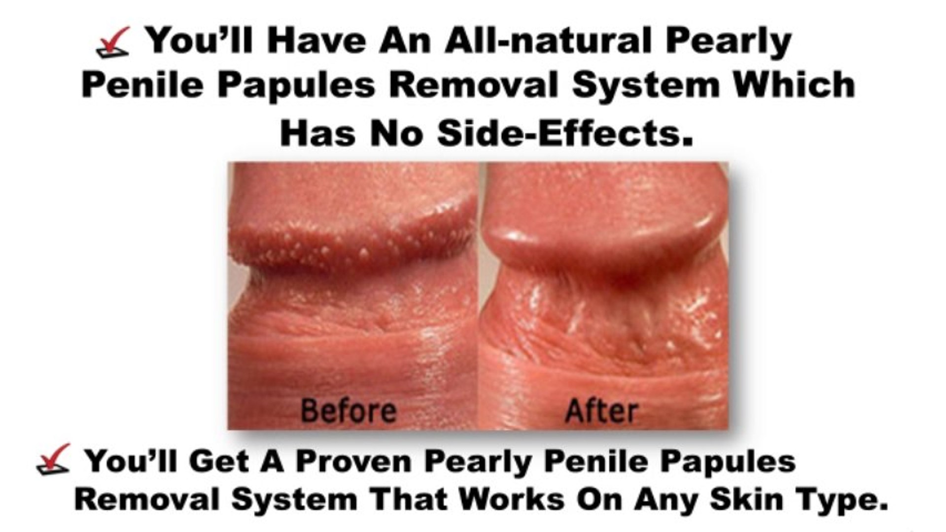 Penile papules treatment