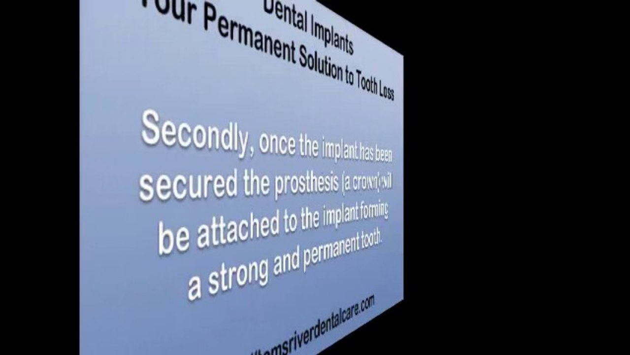 Dental Implants as a Permanent Solution