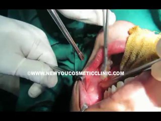 Cheek Reduction Surgery in Bangalore