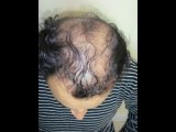 Best hair transplant in pakistan | Fue pakistan | Fue in pakistan