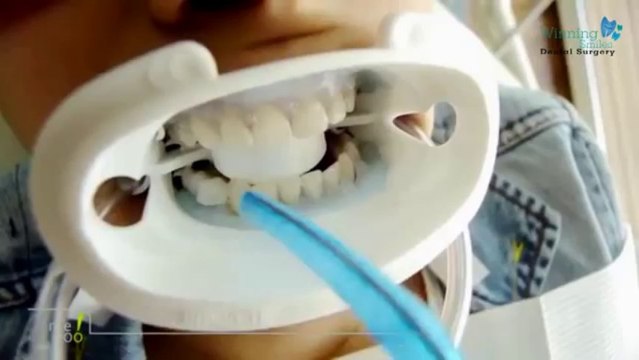 Teeth whitening | Winning Smiles Dental Surgery In Blacktown Nsw Australia