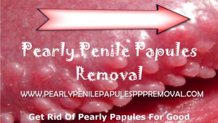 Pearly Penile Removal Methods (pearly penile)