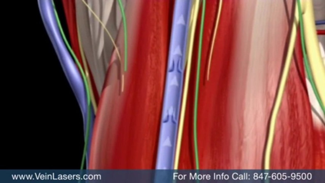 Varicose Vein Treatment Schaumburg Spider Vein Treatment and Vein Clinic Schaumburg