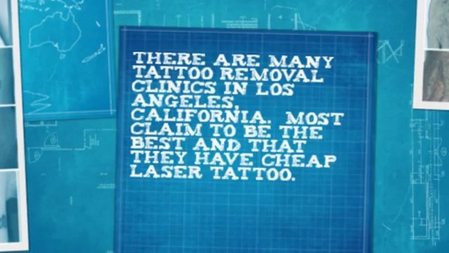 Laser Tattoo Removal and its Benefits