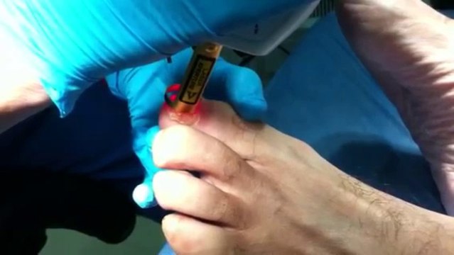 Hongos en la uñas con láser. Tratar los hongos con láser