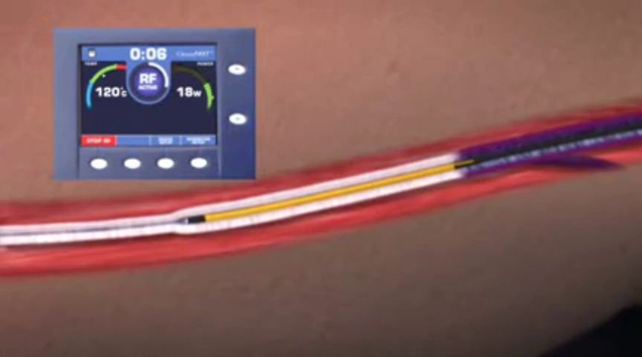 Vein Closure Treatment by Endovenous Radio Frequency Ablation RFA at TVGSC