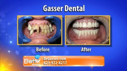Dr Gasser Discusses Dental Implants on Better Arizona