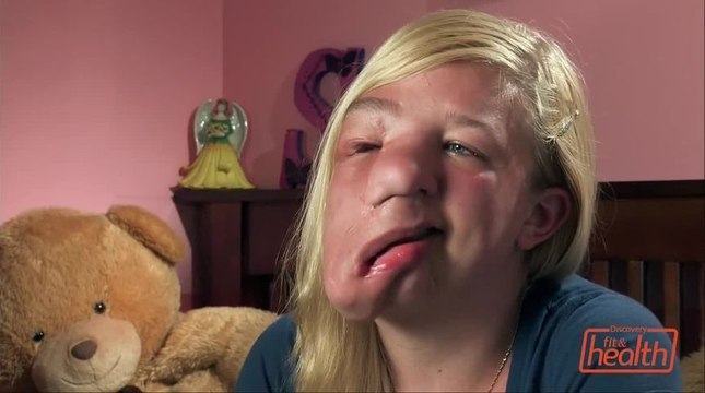 Sarah 17 ans, souffre d'une tumeur qui lui déforme le visage