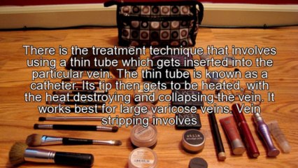 Facts About Varicose Veins Treatment NYC