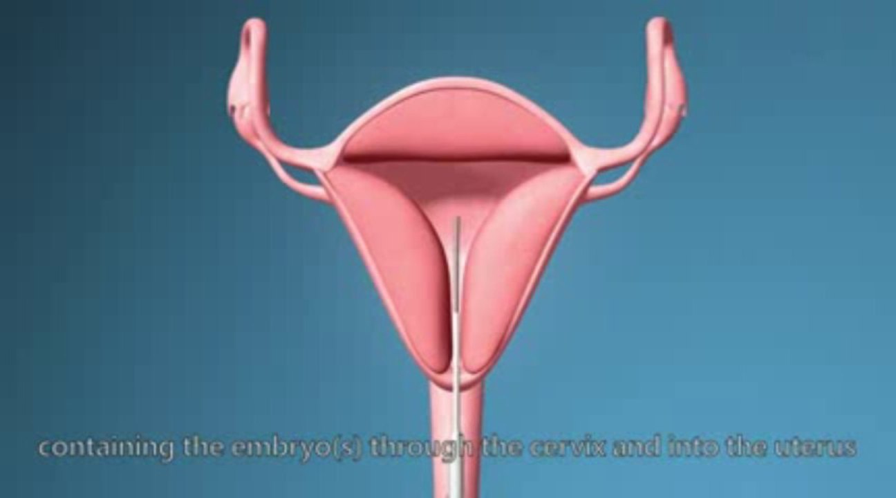 Dr Malpani IVF process procedure in detail step by step - IVF animation