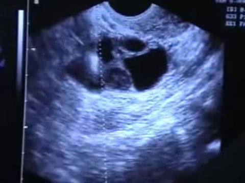 Dr.Malpani In Vitro Fertilization (IVF) Procedure (Part 1)