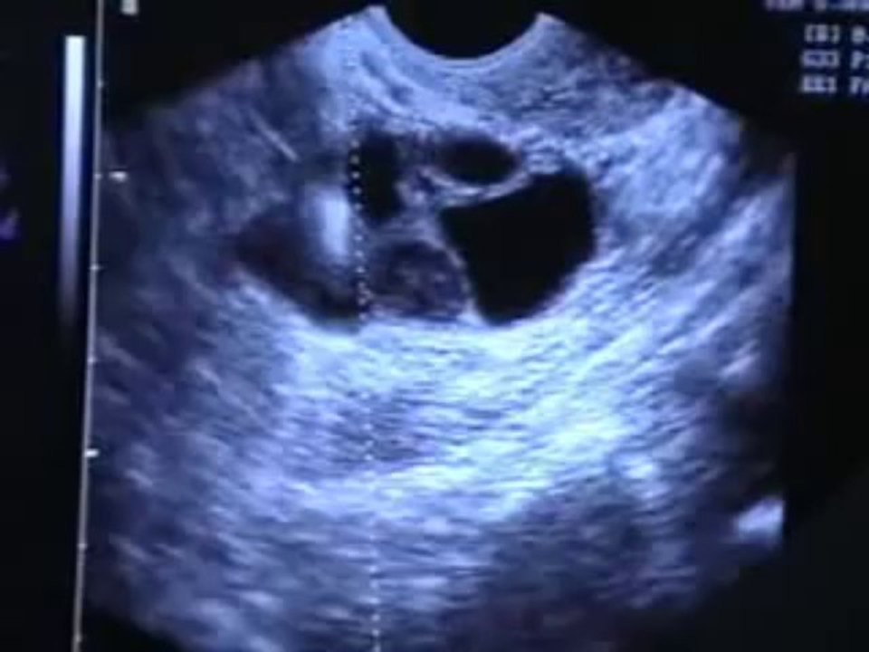 Dr.Malpani In Vitro Fertilization (IVF) Procedure (Part 1)