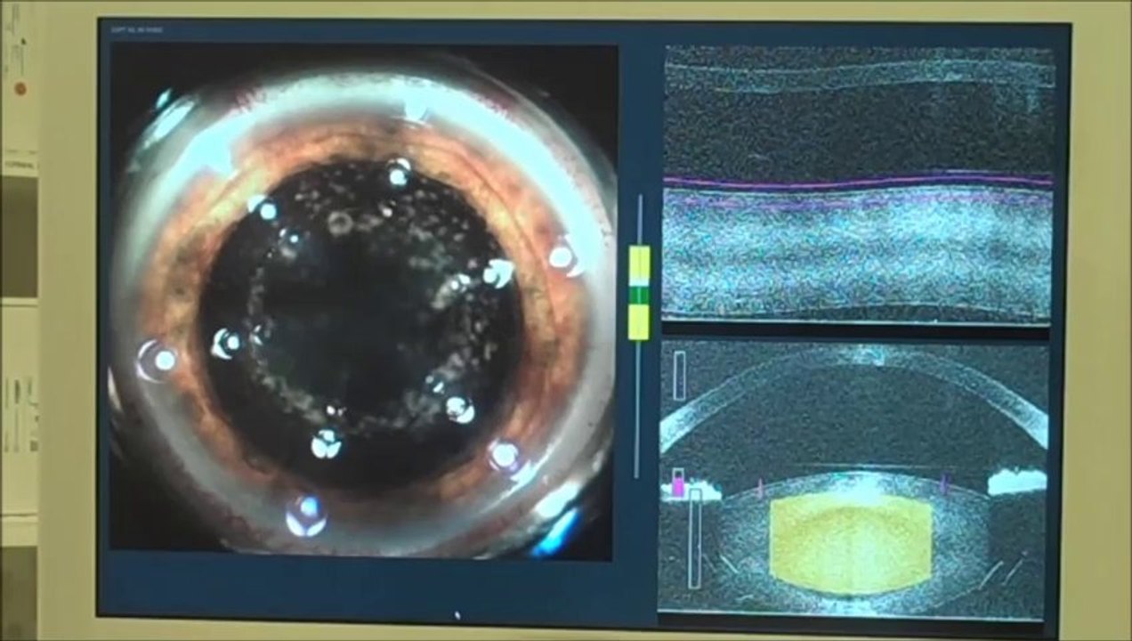 Fort Myers Bladeless Laser Cataract Eye Surgery Ft Myers FL