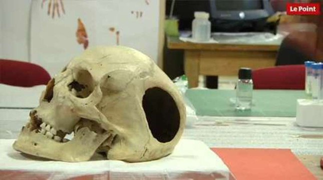 Les incroyables trésors de l'Histoire : le crâne trépané de 4 000 ans du Musée de l'Homme.