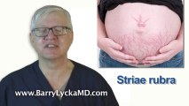 Stretch marks causes & getting rid of stretch marks