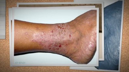 Types of Eczema and Skin Care Tips