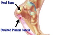 Heel Pain -  Minneapolis,St. Paul, Twin Cities, MN  -   Podiatrist Dale Vancil