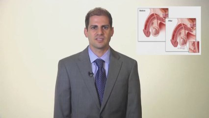 How Does the Vasectomy Procedure Work by St Pete Urology