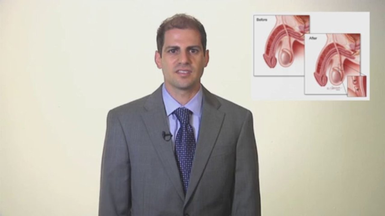 How Does the Vasectomy Procedure Work by Dr. Laryngakis