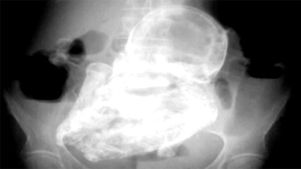 Doctors Discover 40 Year Old Fetus Inside 82 Year Old Woman