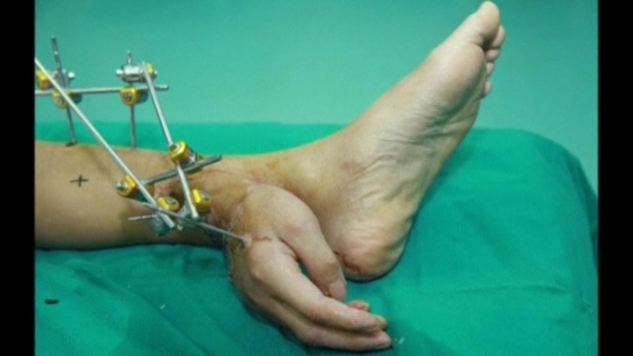 Chinese man's hand grafted onto ankle after accident