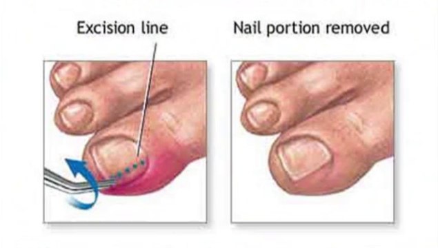 Ingrown Nails - Podiatrist in Oro Valley,Tucson, Green Valley, AZ - Richard Quint, DPM