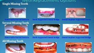 Dr Agravat Dental Implants Ahmedabad India