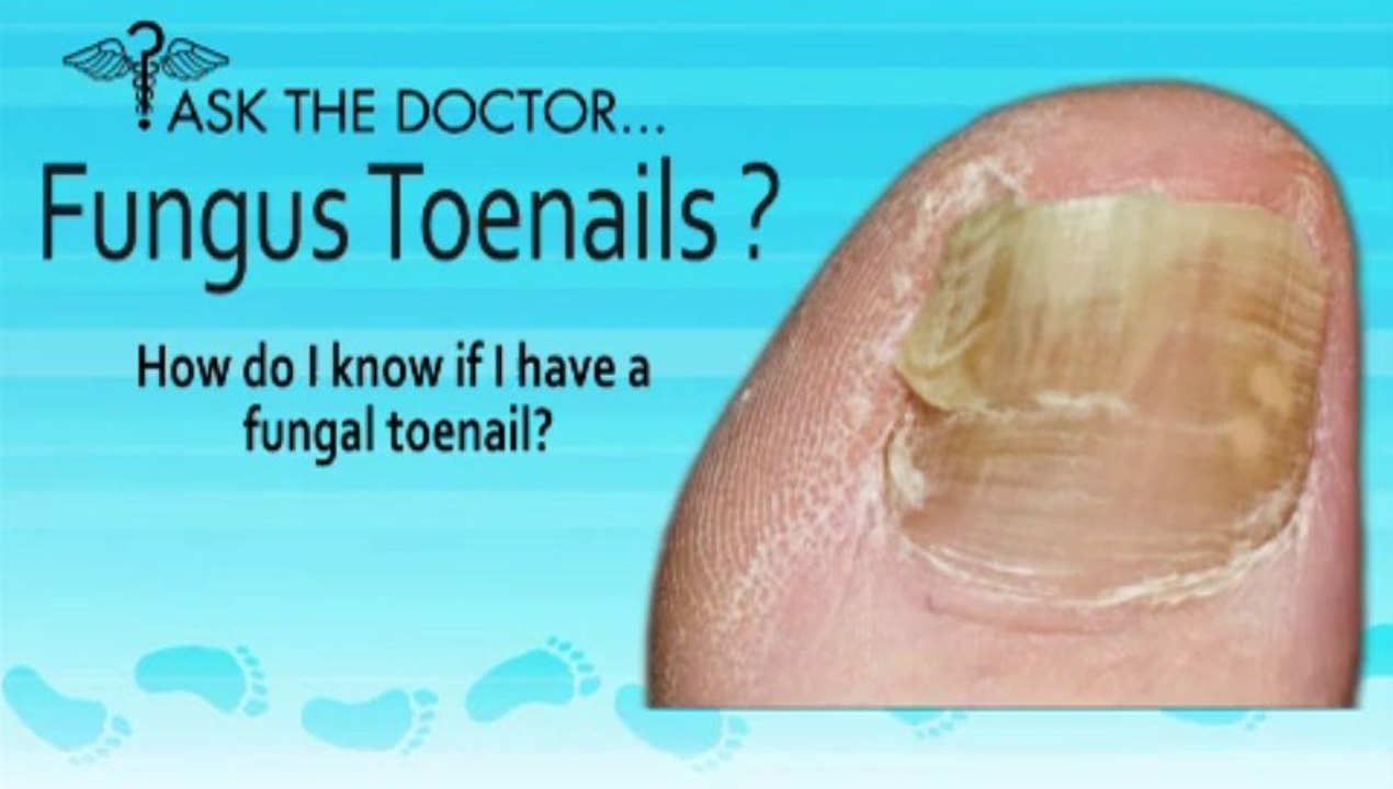 Do I Have Fungal Toenails? Podiatrist in  Newburyport, Chelmsford,Lawrence, MA