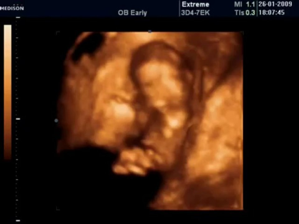 12 Haftalık Bebek Ultrason Görüntüsü Dailymotion Video