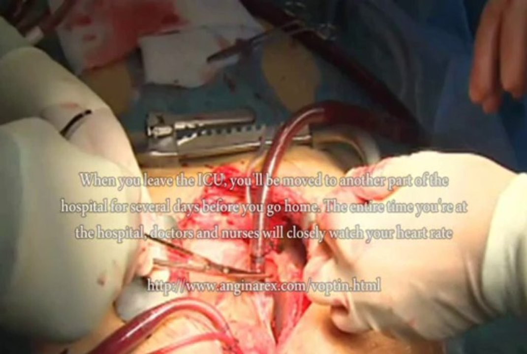 Open Heart Surgery Side Effects, What Are Open Heart Surgery Side Effects