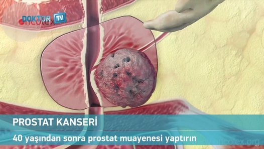 40 Ya&amp;&amp;ndan Sonra Prostat Muayenesi Yapt&amp;r&amp;n Dailymotion Video