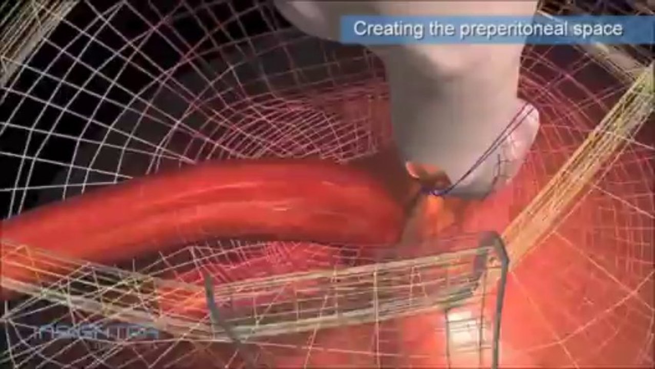 Inguinal Hernia Repair System | Hernia Surgery in Pune | Healing Hands Clinic