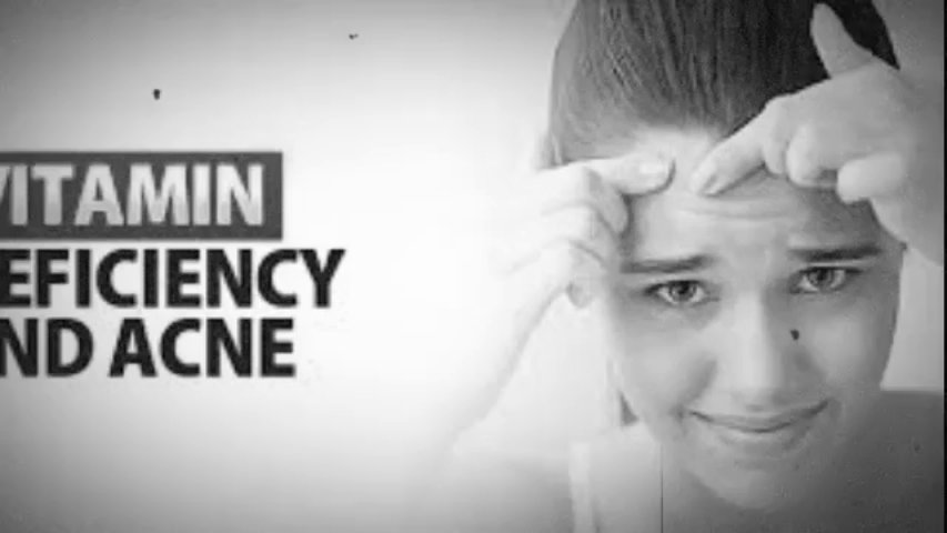 Vitamins For Acne