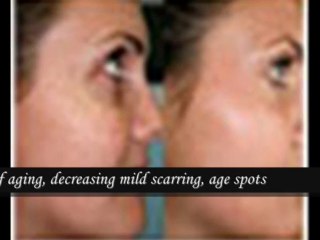 Chemical Skin Peel Brighton