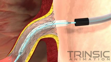 OstialPro Medical Animation