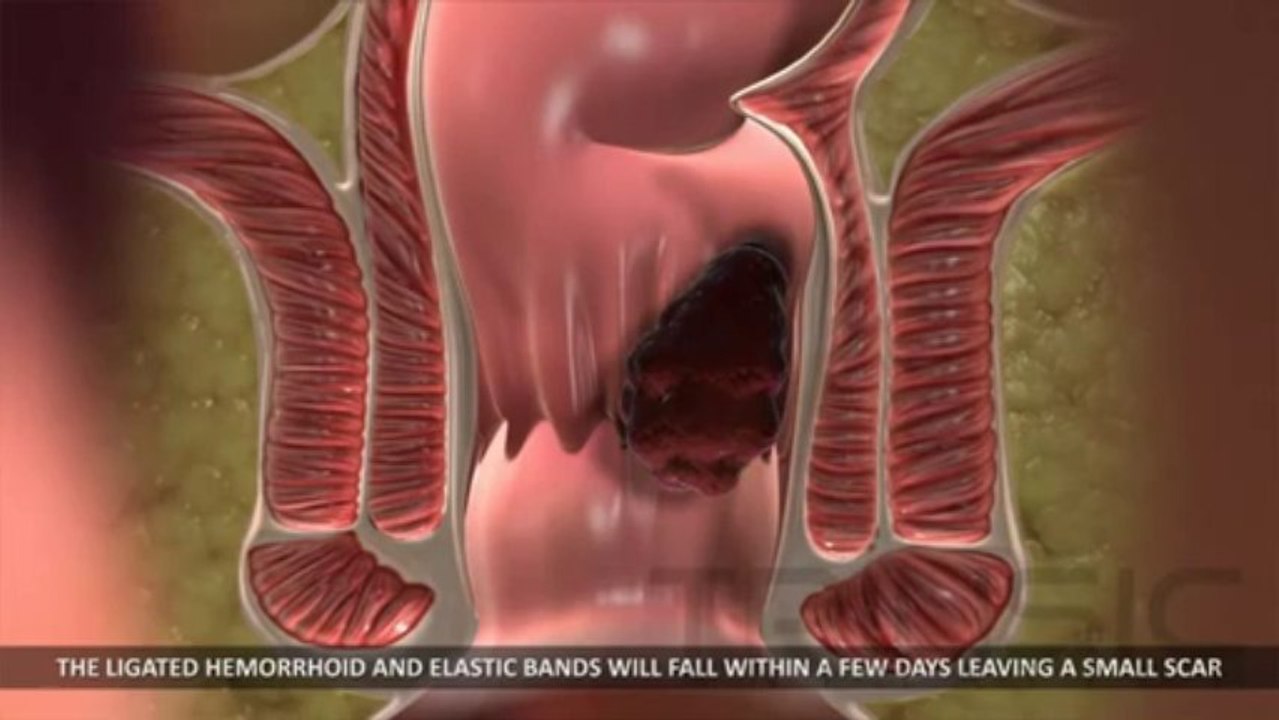 Rubber Band Hemorrhoid Ligation Trinsic Medical Animation video