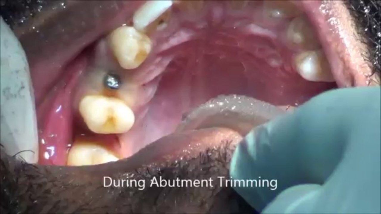 AFFORDABLE DENTAL IMPLANTS IN CHENNAI