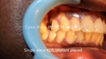 DENTAL IMPLANTS IN INDIA - PERMANENT TEETH IN 1 DAY