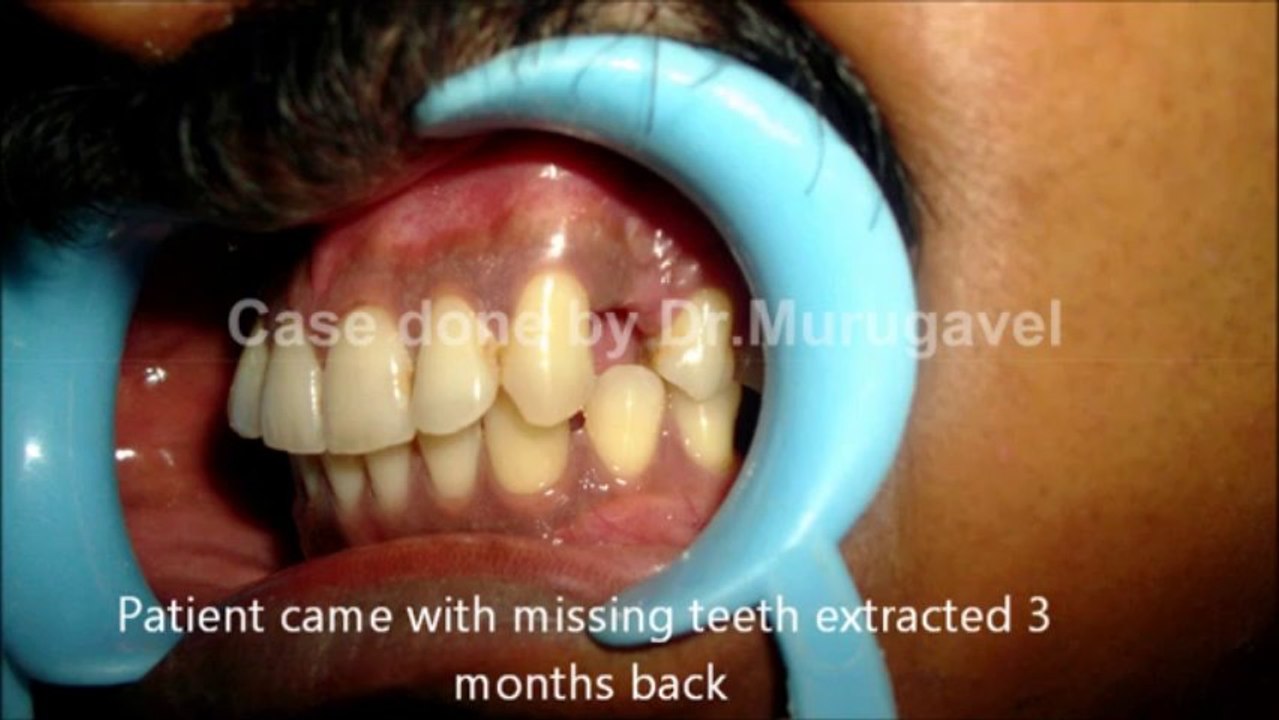 Affordable Dental Implants In chennai