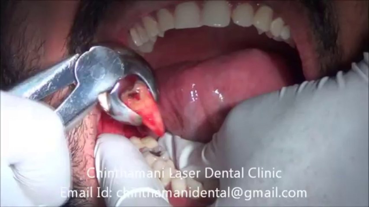 Painless Extraction Of Lower Wisdom Tooth