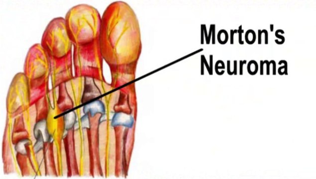 Morton’s Neuroma - Podiatrist Donald Stran - Lake Jackson, Friendswood, Bay City TX