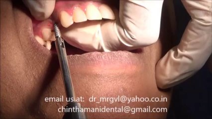 AFFORDABLE DENTAL IMPLANT IN CHENNAI