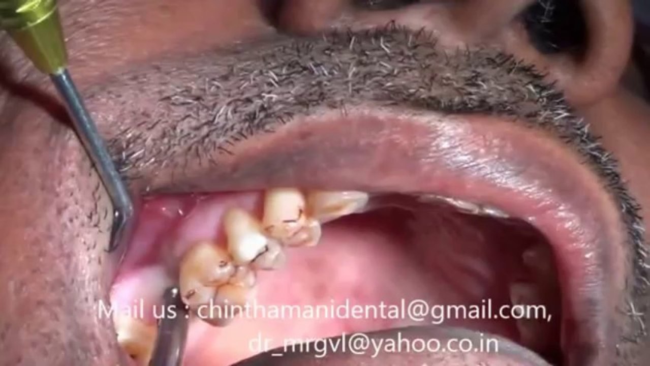 Flapless KOS Dental Implant placement in molar region video