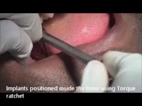 Flapless KOS Dental Implants for Lower molars in Chennai